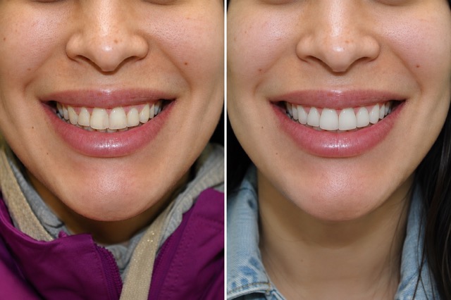 Micro-Thin Veneer Enhancement